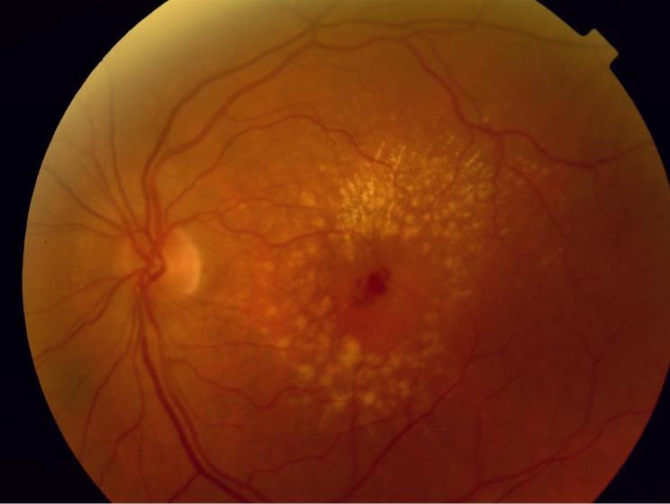 RAP retinal