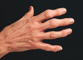 2. Inflammatoriska ryggsjukdomar + PsA Psoriasisartrit (PsA).