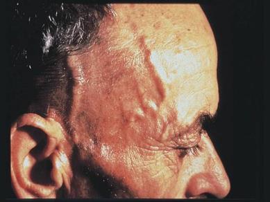 3. Inflammatoriska systemsjukdomar + GCA/PMR Temporalisarterit (TA/GCA) och polymyalgia rheumatica (PMR) sköts som regel i primärvården.