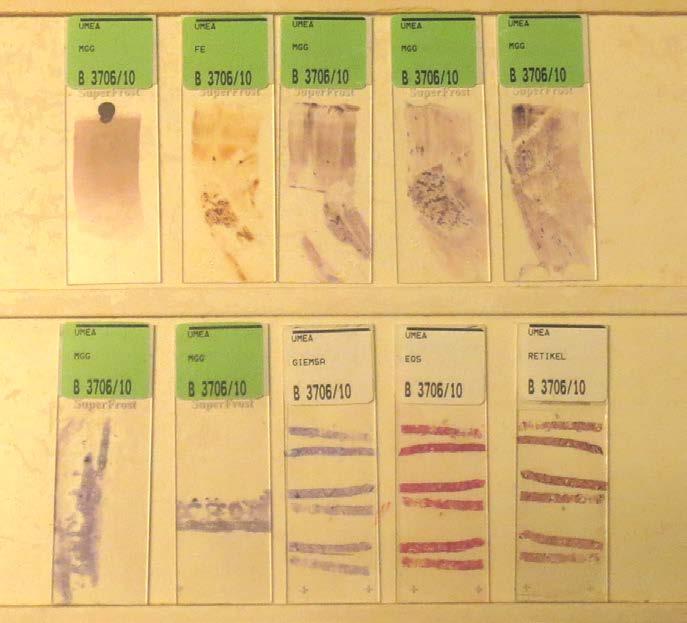 Benmärgsbiopsi Benmärg imprints (MGG)