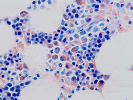 Polycytemia vera (PV) och sekundär polycytemi (SP) Incidens av fynd I