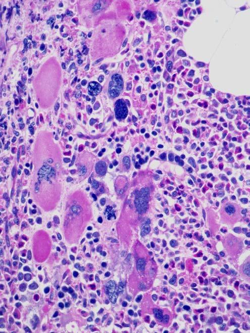 WHO 2017 histologiska kriterier för PMF Megakaryopoes Prefibrotisk myelofibros Små till stora megakaryo cyter med