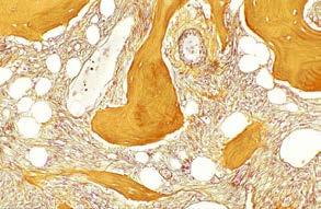 Histopatologi och klinik i progressiv myelofibros