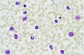 myelofibros associerat med extramedullär hematopoes