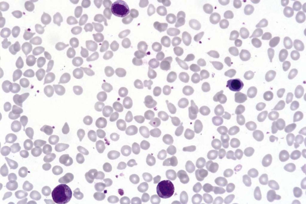 PMF Ortokromatisk normoblast Tear-drop poikylocytos (dacrocyter) Blood and