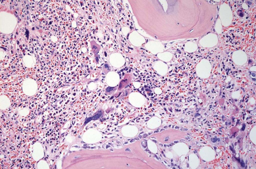 PMF Ben-nybildning Blood and Bone Marrow Pathology.