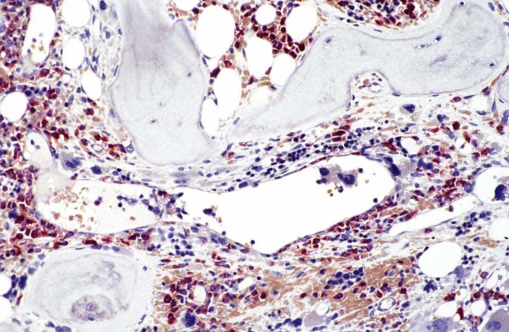 PMF Intrasinusiodala hematopoetiska celler Blood and Bone Marrow