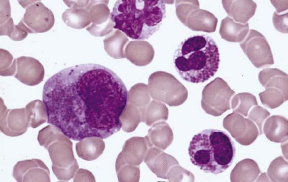 Kronisk eosinofil leukemi (CEL) 1. Eosinofili 1,5x10 9 /l 2. Ej hållpunkter för KML, PV, ET, PMF, CNL, KMML, BCR-ABL1-negativ atypisk KML 3.