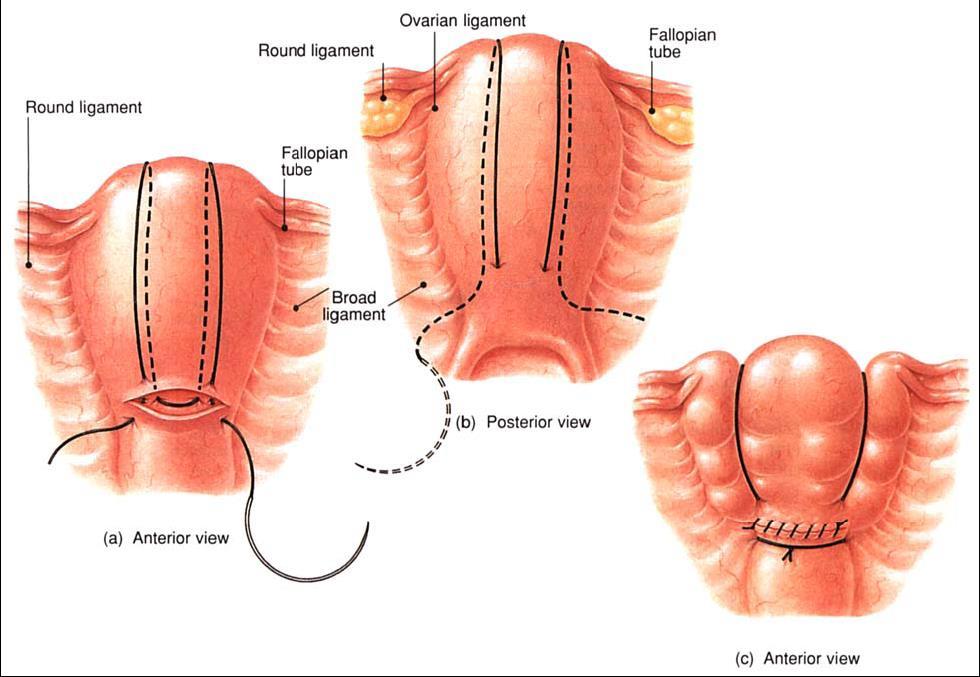 D. Kirurgisk behandling Placentakontroll och exploration av uterus, kontroll av cervix-vagina Kontrollera placenta och explorera uterus i narkos/spinal, samtidigt kontroll av cervix och vagina.
