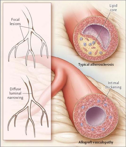 Cardiac allograft vasculopathy,