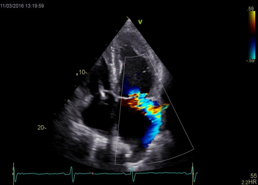 Fall 3 tryckinformation Hjärtkateterisering beräknar den pulmonella vaskulära