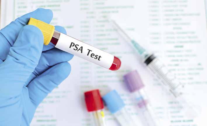 AVHANDLINGAR Vitamin D och prostatacancer Prostatacancer är den vanligaste manliga cancerformen med över 000 nya fall 204.