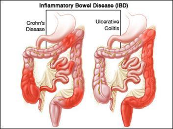 Inflammatorisk tarmsjukdom (IBD) Inflammatory bowel disease(ibd) är en kronisk inflammation i
