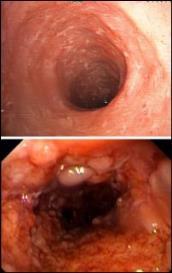 Sjukdomen indelas i: Crohns sjukdom inflammationen kan uppträda i hela mag-tarmkanalen