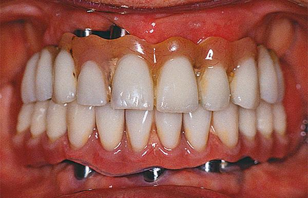 Förutom tänder och proteser ska munslemhinnor och tunga rengöras. Vid intorkat slem ska slemlösande medel användas.