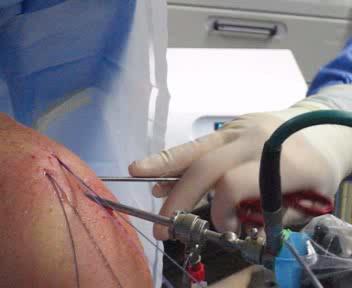 Artroskopisk Rotator Cuff sutur Cuff ruptur! Supraspinatus! Supra + Infraspinatus!