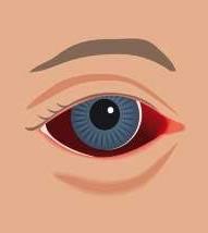 Synen Med åldrande minskar pupillens storlek vilket gör att förmågan att släppa in ljus försämras, beroende av ljus för att se Linsens muskelspänning ändras, behov av läsglasögon ökar med