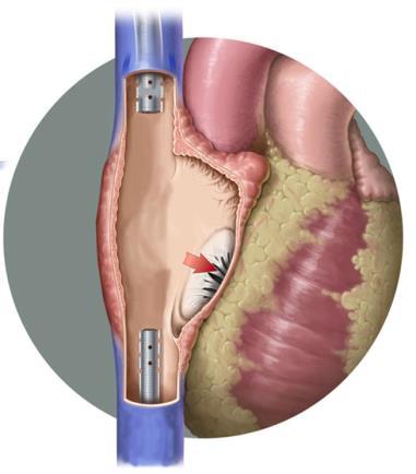 Viktigt att katetern ligger så att den arteriella jet:en blir riktad mot tricuspidalisöppningen. Rätt rotation är när kateterns artärdel är riktad mot örat.