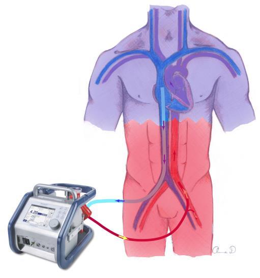 Perifert kanylerad VA-ECMO vid respiratorisk svikt Patienter med grav respiratorisk svikt kan få sekundär cirkulatorisksvikt varför man ibland inte vågar lägga dem på VV- ECMO-primärt utan väljer då