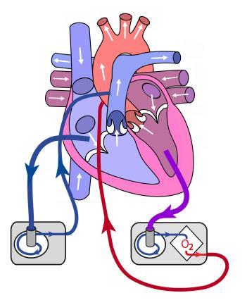 BiVAD med vänster kammarkanyl När både höger och vänster kammare sviktar (biventrikulär svikt) kan man hjälpa höger kammare med en RVAD och vänster kammare med en LVAD; tillsammans kallas detta BiVAD.