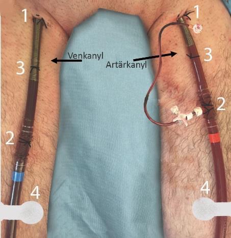 Skötsel och omläggning av ECMO-kanyler Fixation av kanyler är viktigt.
