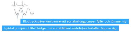 Cirkulation VA-ECMO ger ett cirkulationsstöd, dock inte ett stöd för hjärtat eftersom det retrograda ECMO-flödet ökar belastningen för vänster kammare.