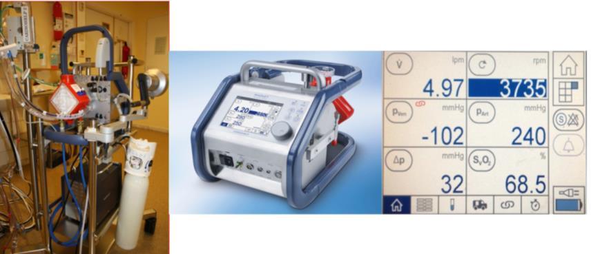 CARDIOHELP Cardiohelp är en portabel ECMO apparat där centrifugalpump och oxygenator (HLS-set (Maquet )) integrerats till en enhet. Dess kontrollenhet övervakar bl.a. flöde, slangtryck och ingående syrgasmättnad.