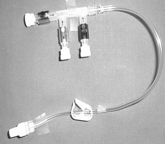 Extravasal infusion (sker om katetern glidit ur kärlet eller om katetern spruckit/gått av) Symtom Inget återflöde i venkateter eller smärta vid infusion. Åtgärder Stäng av pågående infusion.