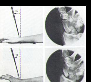 Röntgenröret vinklat 15º distalt, handen supinerad 10-15º. 2.