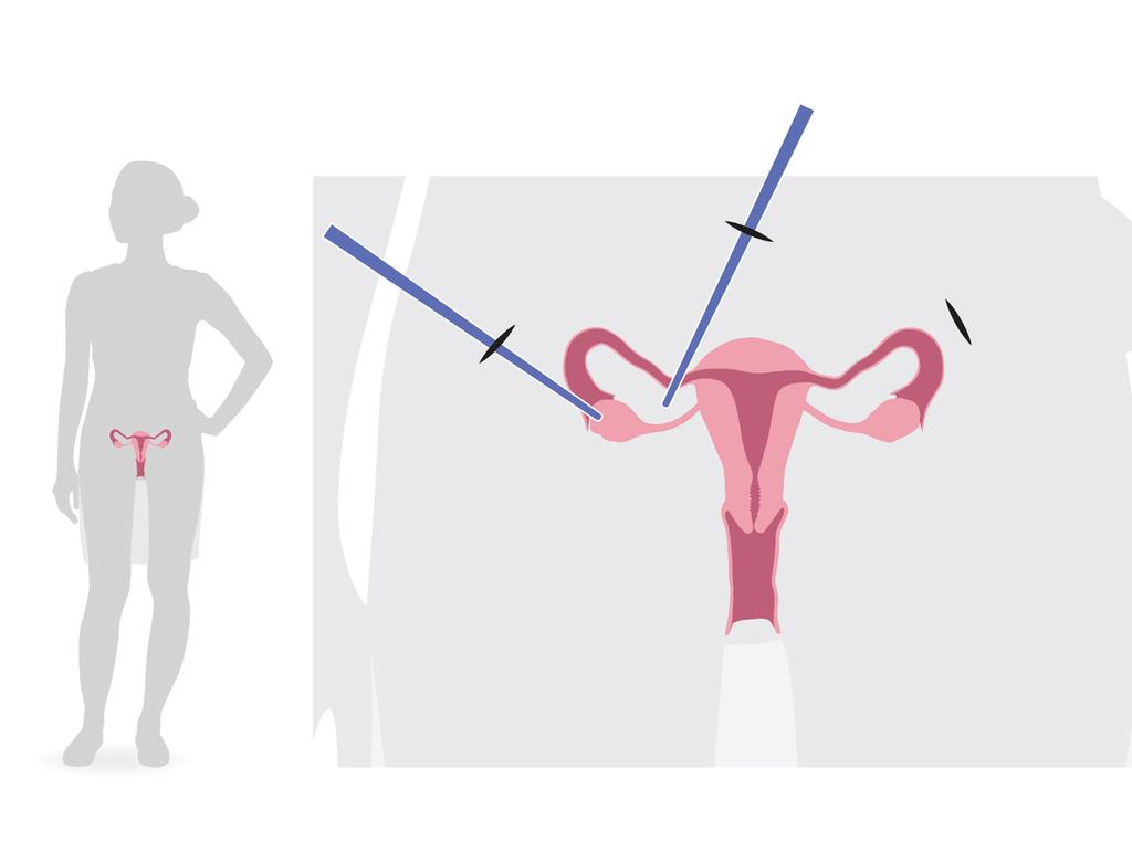 Titthålsoperation Titthål Äggstock Livmoder Hur tas en bit av äggstocken ut? Du kommer att vara sövd och inte känna något.