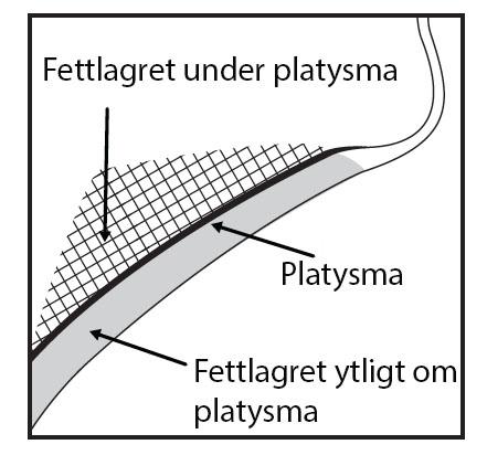 mellan dermis och platysma (fettlagret ytligt om platysma) inom det önskade behandlingsområdet (bild 2). Bild 2.