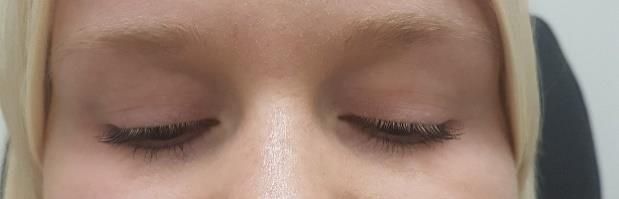 Blinkningar där hela cornea täcktes av ögonlocket räknas som fullständiga