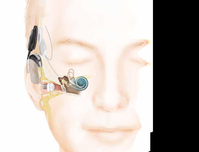Hörselnervtrådarna i cochlean fångar upp signalerna 4 och skickar dem till hjärnan, vilket ger förnimmelsen av ljud.