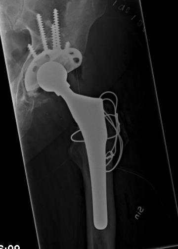 Fixation with screws Fixation