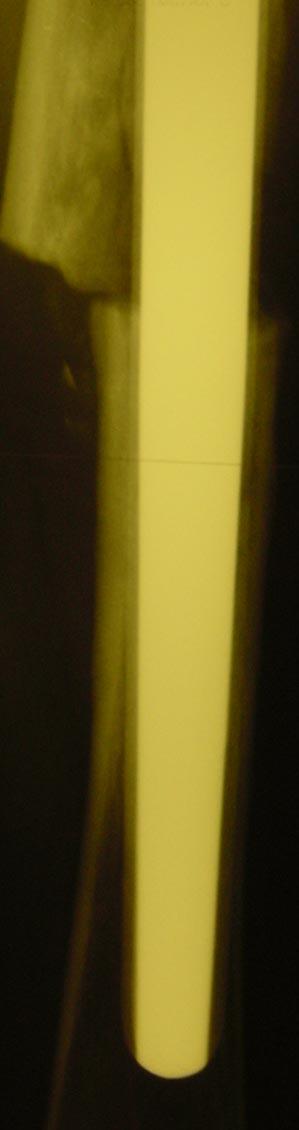 Postop 10