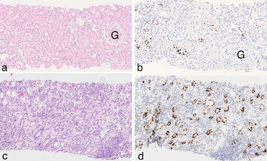 kopior/ml i serum eller plasma (2, 6), men även vid lägre virusnivåer (BKV DNA 1000-10 000 kopior/ml i serum/plasma) kan det finnas risk för utveckling av BKVAN (2, 6).
