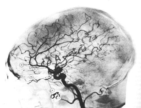 Pneumoencephalogram