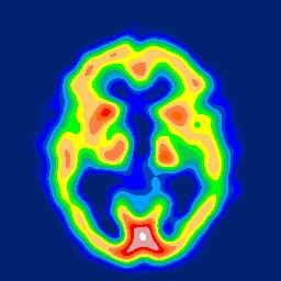 Subkortikalt ses sänkt flöde huvudsakligen frontalt. Vaskulär hjärnsjukdom Sjukhistoria: 69-årig man med hypertoni och angina pectoris.