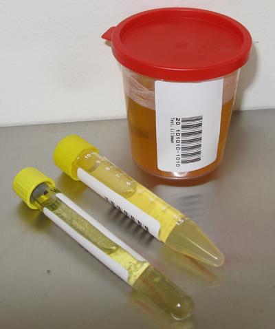 Att tänka på vid urinprovtagning Patient-ID på provtagningskärl Rent