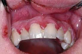 Primärinfektion oral herpes Herpetisk