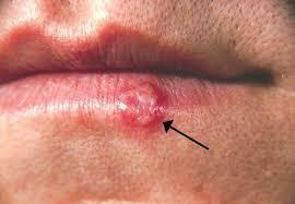 Reaktivering oral/ labial herpes Mildare symtom än vid primärinfektion Latenta virus ofta i n.