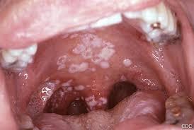 gingivit/ stomatit Svamp Virus