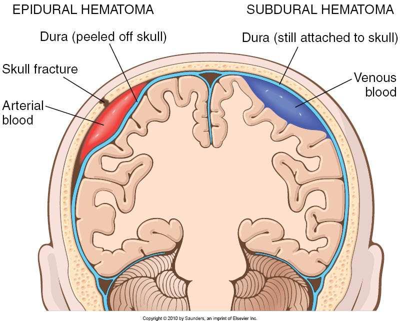 Traumatiska skador till blodkärl Epidural blödning Subdural blödning Epidural blödning 1. Arteriell blödning: Dural artär skadad av benfragment 2.