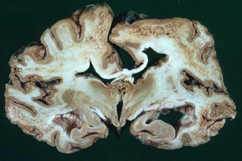transplantation, galna ko-sjukan (BSE) Kuru: I samband med rituell kannibalism (Nya Guinea) Prionsjukdomar: Creutzfeld-Jakob sjukdom Mikroskopiskt utseende Förlust av nervceller Undergång av