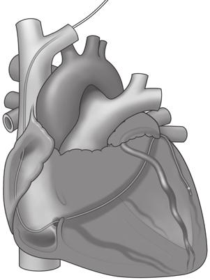 2 2 Anterior-posterior (AP) vy av det koronarvenösa systemet 1 3 4 5 8 1 7 6 Förklaring: 1. Elektrod 2. Ostium på Sinus coronarius 3. Sinus coronarius 4. V. cordis media 5. V. posterior sinistra 6. V. anterior 7.