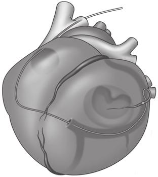 V. posterior sinistra 6. Vänstra marginalvenen 7. V. cordis magna 8. V. anterior NOTERA: Venografi rekommenderas för att visa patientens koronarvenösa anatomi.