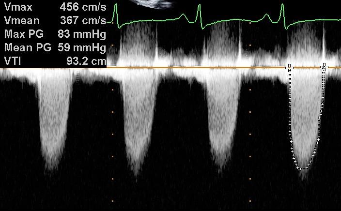 Exempel#1 Mean gradient 30 mmhg Mean gradient 59 mmhg Vila Dobutamin 20