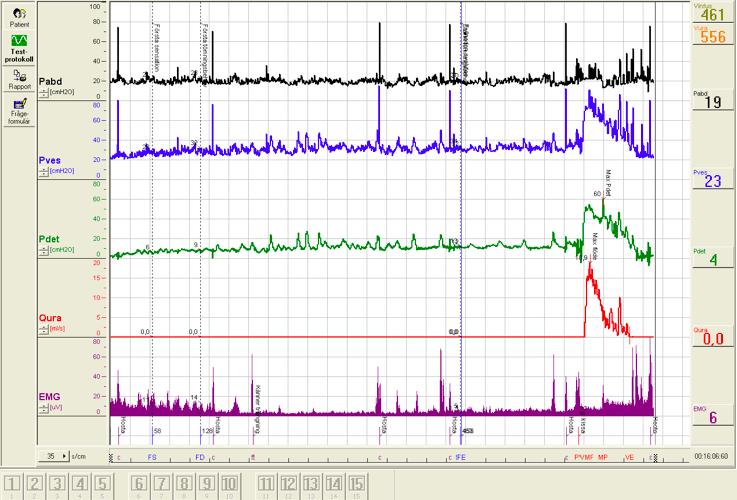 Cystometri med EMG-registrering - detrusoröveraktivitet