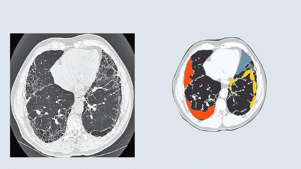 DIAGNOS IPF är en allvarlig sjukdom som kan vara svår att diagnostisera. Tidiga symtom som andfåddhet redan vid lättare ansträngning och torrhosta assoccieras kanske inte omedelbart med IPF.