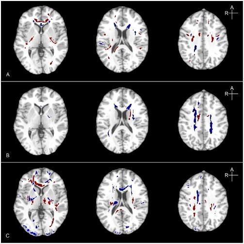Variation in the spatial distribution of FA abnormalities across patients.